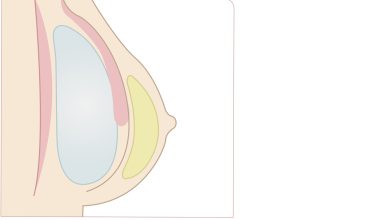Qual benefício de colocar a prótese de silicone pela técnica Dual plane