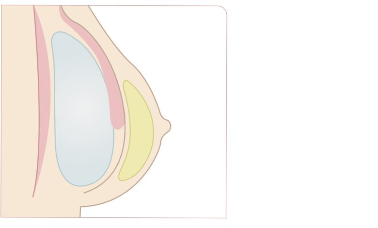 Qual benefício de colocar a prótese de silicone pela técnica Dual plane
